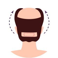 FUT (Follicular Unit Transplant)