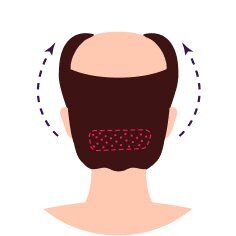 FUE (Follicular Unit Extraction)