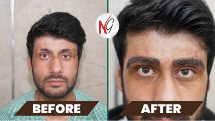 eyebrow-hair-transplant-before-after-1 eyebrow-hair-transplant-before-after-1