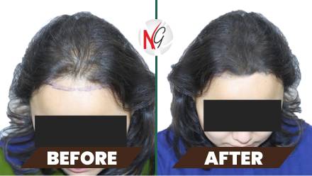 female-hair-transplant-before-after-1 female-hair-transplant-before-after-1