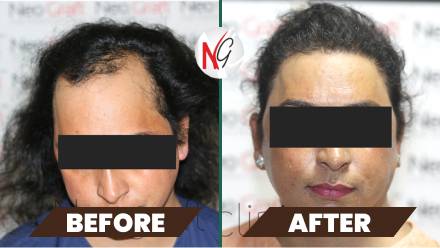 female-hair-transplant-before-after-2 female-hair-transplant-before-after-2