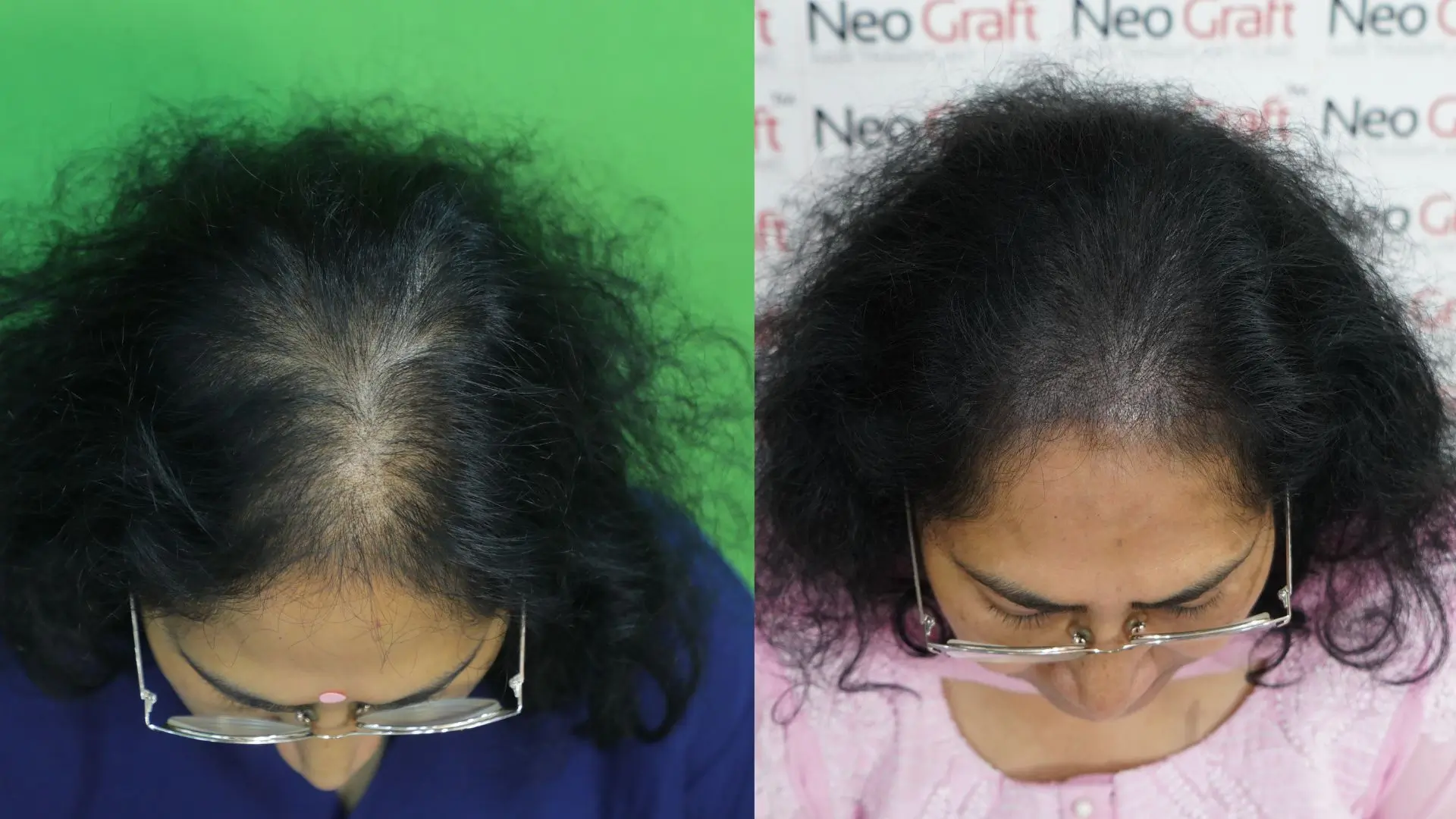 smp Scalp Micropigmentation