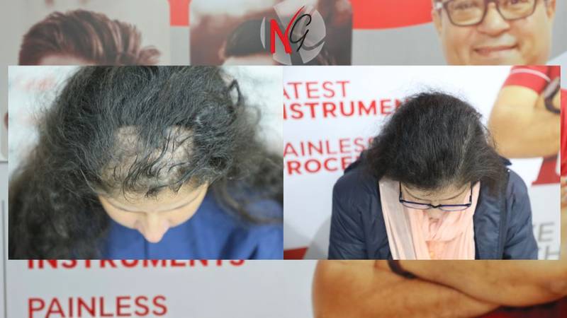 female hair transplant female hair transplant neograft chandigarh<br />